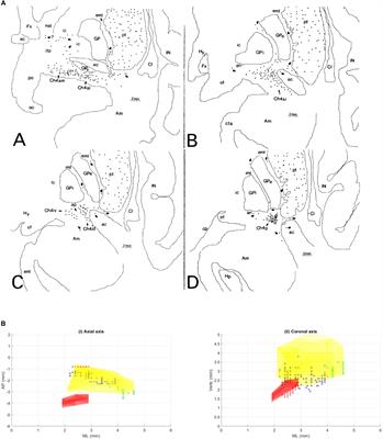 Nucleus Basalis of Meynert Stimulation for Dementia: Theoretical and Technical Considerations